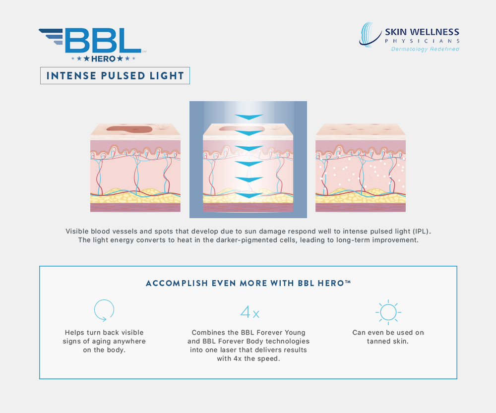 Discover how IPL with BBL Hero works to treat visible vessels and sun-damage spots in the skin at Skin Wellness Physicians.