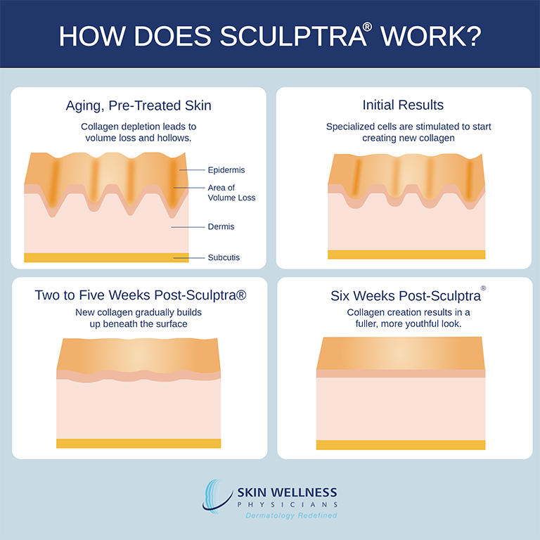 See the six-week results of Sculptra® at Naples and Marco Island’s Skin Wellness Physicians.