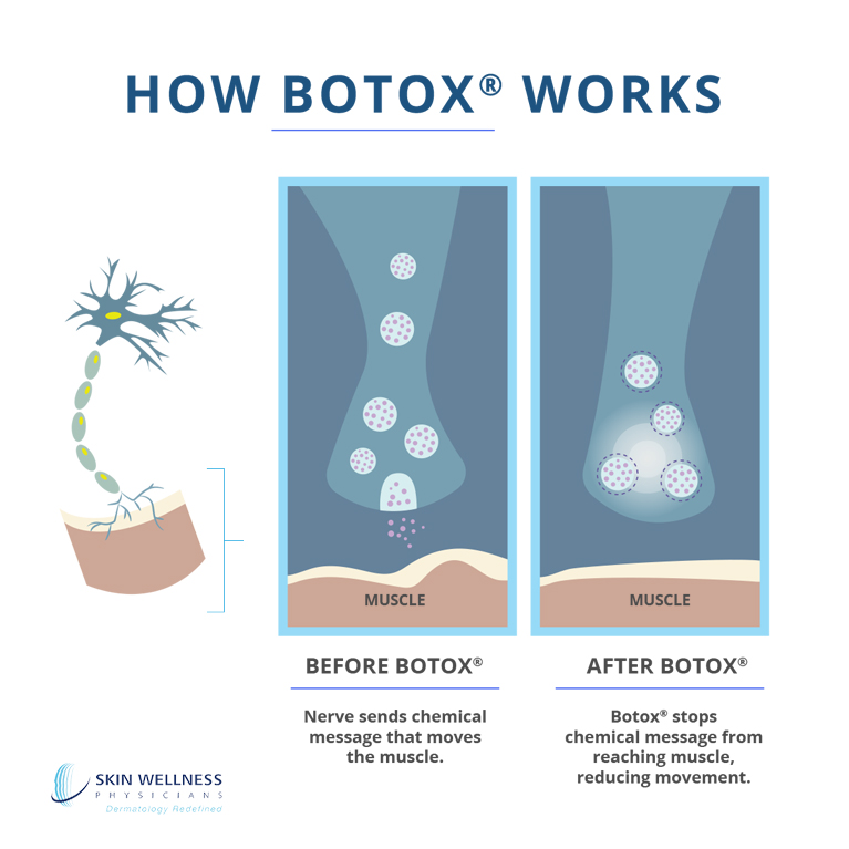 Get an 'inside look' at how we use BOTOX® at Florida's Skin Wellness Physicians to reduce muscle activity—and wrinkles—on the face.