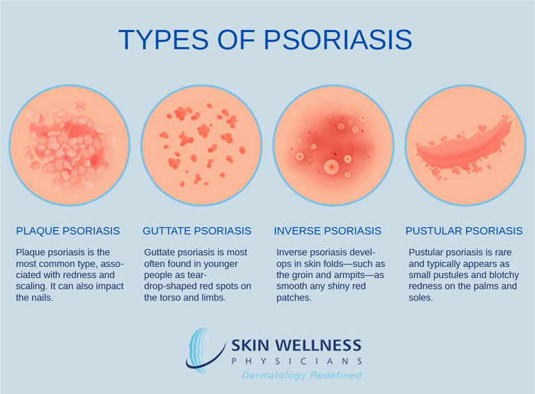 Learn about the four types of psoriasis from Naples and Marco Island’s Skin Wellness Physicians.